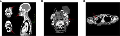 Case report: Prompt response to radiotherapy and chemotherapy combined with crizotinib in gingival sarcomatoid squamous cell carcinoma with MET 14 mutation